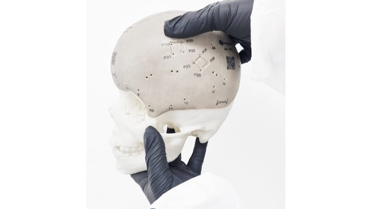 Utilizando tecnología de impresión 3D: Startup fabrica el implante craneal más grande del mundo 