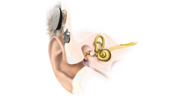 Implantes cocleares: tecnología que permite disfrutar de los sonidos a las personas con hipoacusia